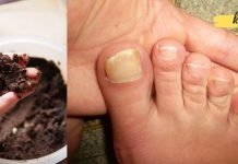 როგორ მოვიშოროთ სოკო მარტივად ძვირადღირებული მედიკამენტების გარეშე? ეს ყველამ უნდა იცოდეს!