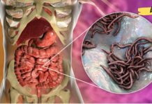 4 რეცეპტი, რომელიც დაგეხმარებათ ორგანიზმიდან პარაზიტების მოცილებაში ძალიან მოკლე ხანში! უნდა სცადოთ!