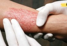 ფსორიაზი: მიზეზები, სიმპტომები და ვიტამინი, რომლის ნაკლებობაც იწვევს მას!