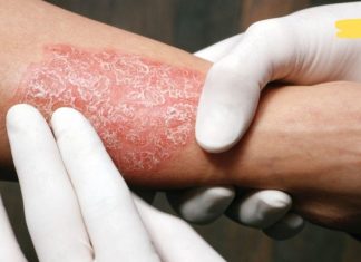 ფსორიაზი: მიზეზები, სიმპტომები და ვიტამინი, რომლის ნაკლებობაც იწვევს მას!