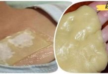 თაფლისა და ჯანჯაფილის კომპრესი მკურნალობს ძლიერ ხველას და აშორებს ლორწოს ფილტვებიდან მხოლოდ ერთ ღამეში. წარმოუდგენელი შედეგი!