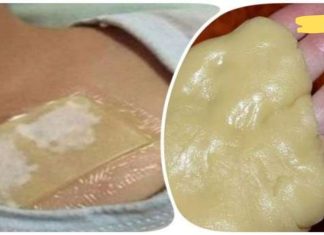 თაფლისა და ჯანჯაფილის კომპრესი მკურნალობს ძლიერ ხველას და აშორებს ლორწოს ფილტვებიდან მხოლოდ ერთ ღამეში. წარმოუდგენელი შედეგი!