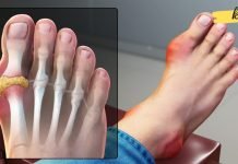 როგორ ამოიღოთ შარდმჟავას კრისტალები თქვენი სხეულიდან პოდაგრის თავიდან ასაცილებლად? ეს ბევრს დააინტერესებს