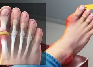 როგორ ამოიღოთ შარდმჟავას კრისტალები თქვენი სხეულიდან პოდაგრის თავიდან ასაცილებლად? ეს ბევრს დააინტერესებს