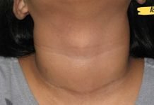 მეთოდი, რომლის მეშვეობითაც შევძელი ჩიყვის განკურნება. ამის შესახებ ბევრმა არ იცის!