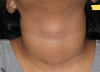 მეთოდი, რომლის მეშვეობითაც შევძელი ჩიყვის განკურნება. ამის შესახებ ბევრმა არ იცის!