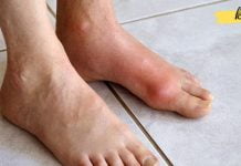 ყველაფერი ნიკრისის ქარის (პოდაგრა) შესახებ: რა არის, რა იწვევს და როგორ ვუმკურნალოთ მას სახლის პირობებში?