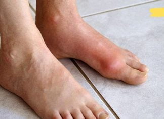 ყველაფერი ნიკრისის ქარის (პოდაგრა) შესახებ: რა არის, რა იწვევს და როგორ ვუმკურნალოთ მას სახლის პირობებში?