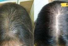 მე თმის ცვენა დაფნის ნახარშის გამოყენებით შევიჩერე. თქვენც გირჩევთ!