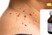 როგორ მოვიშოროთ ერთხელ და სამუდამოდ შემაწუხებელი პაპილომები? ეს აქამდე უნდა მცოდნოდა