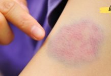 რატომ გვიჩნდება კანზე სილურჯეები? ამის შესახებ ბევრმა არ იცის!