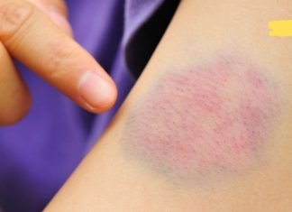 რატომ გვიჩნდება კანზე სილურჯეები? ამის შესახებ ბევრმა არ იცის!