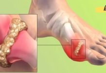 ამ მეთოდით შევიმცირე პოდაგრით გამოწვეული აუტანელი ტკივილები!. ეს რომ აქამდე მცოდნოდა..