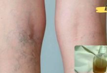 ეს ბუნებრივი ბალზამია, რომელიც წარმატებით გამოიყენება სისხლძარღვთა ბადეების მოსაშორებლად! თქვენც უნდა სცადოთ!