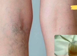 ეს ბუნებრივი ბალზამია, რომელიც წარმატებით გამოიყენება სისხლძარღვთა ბადეების მოსაშორებლად! თქვენც უნდა სცადოთ!