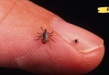 რა არ უნდა გააკეთოთ, თუ ტკიპამ დაგკბინა? აუცილებლად გასათვალისწინებელია!