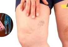 10 საკვები, რომელიც ათხელებს სისხლს და ხელს უშლის სისხლის შედედებას