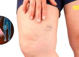 10 საკვები, რომელიც ათხელებს სისხლს და ხელს უშლის სისხლის შედედებას