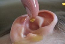 როგორ გავიყუჩოთ ყურის ტკივილი 1 წუთში. წვეთები, რომლებიც ნამდვილად ეხმარება!