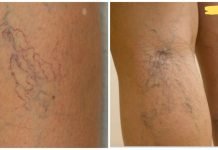 მოიცილეთ ვარიკოზული ვენები და თრომბოზი მხოლოდ 2 მარტივი ინგრედიენტით!