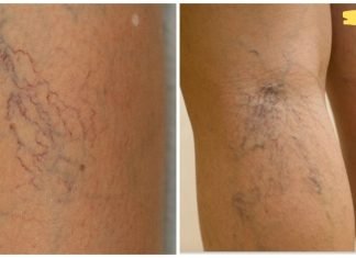 მოიცილეთ ვარიკოზული ვენები და თრომბოზი მხოლოდ 2 მარტივი ინგრედიენტით!
