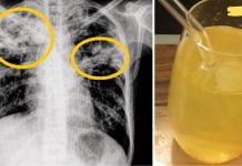 ეს 5 საშუალება სწრაფად და ეფექტურად აქრობს ნახველს და ლორწოს! აქ აუცილებლად იპოვით თქვენთვის სასარგებლო რეცეპტს!