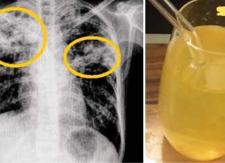 ეს 5 საშუალება სწრაფად და ეფექტურად აქრობს ნახველს და ლორწოს! აქ აუცილებლად იპოვით თქვენთვის სასარგებლო რეცეპტს!