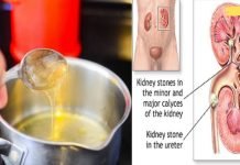 საუკეთესო მცენარეული საშუალებები თირკმლის ქვების მოსაშორებლად! ეფექტურია!