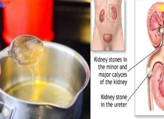 საუკეთესო მცენარეული საშუალებები თირკმლის ქვების მოსაშორებლად! ეფექტურია!