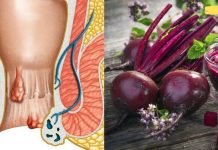 ვისაც ბუასილი აწუხებს, კარგად იცის ამ ტანჯვის შესახებ. ჩვენ გთავაზობთ უსწრაფეს მეთოდს