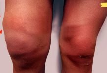 სახსარში დაგროვებული სითხის დროს გამოიყენეთ ტყემლის ტყლაპი. გამოცდილია!