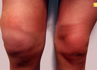 სახსარში დაგროვებული სითხის დროს გამოიყენეთ ტყემლის ტყლაპი. გამოცდილია!