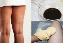 ერთადერთი საშუალება, რომელიც ნამდვილად მუშაობს ცელულიტის მოცილებაში! დაგაინტერესებთ!