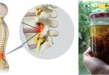 საჯდომის ნერვის ტკივილის შემსუბუქება მედიკამენტების გარეშე: 2 ყველაზე ძლიერი ბუნებრივი მკურნალი..