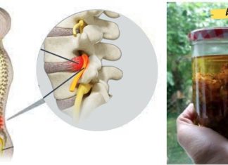 საჯდომის ნერვის ტკივილის შემსუბუქება მედიკამენტების გარეშე: 2 ყველაზე ძლიერი ბუნებრივი მკურნალი..