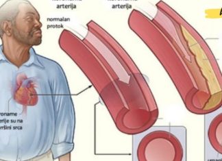 გაასუფთავეთ არტერიები და თავიდან აიცილეთ გულის შეტევა