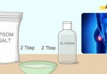 Epsom მარილი და გლიცერინი ბუასილის სამკურნალოდ. ნახეთ როგორ უნდა გამოიყენოთ ის!