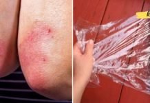 ფსორიაზის სამკურნალო ხალხური მეთოდები.. აი რა უნდა გააკეთოთ ამ დროს..