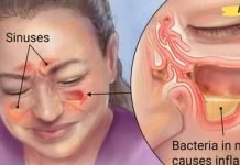 მოიშორეთ ჰაიმორიტი შავი ჩაით. აი როგორ..