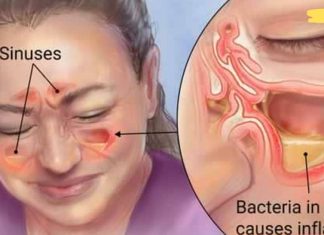 მოიშორეთ ჰაიმორიტი შავი ჩაით. აი როგორ..