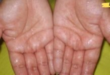 რატომ გვიოფლიანდება ხელისგულები? მიზეზები და მკურნალობის მეთოდები!