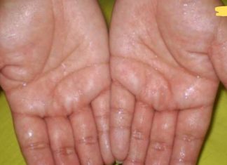 რატომ გვიოფლიანდება ხელისგულები? მიზეზები და მკურნალობის მეთოდები!