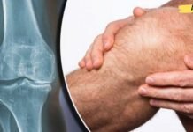 ნატურალური საშუალება მტკივნეული და შეშუპებული მუხლებისთვის. საჭიროა მხოლოდ ორი ინგრედიენტი..