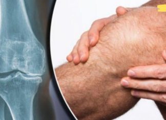 ნატურალური საშუალება მტკივნეული და შეშუპებული მუხლებისთვის. საჭიროა მხოლოდ ორი ინგრედიენტი..