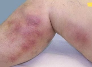 სისხლის შედედება (თრომბი): სიმპტომები, რომლებსაც შეუძლიათ თქვენი სიცოცხლის გადარჩენა