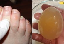 აი როგორ უნდა მოვირჩინოთ ფრჩხილის სოკო კვერცხისა და ძმრის დახმარებით.. ეფექტური მეთოდია..