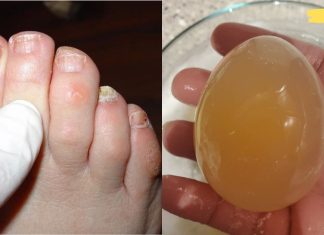 აი როგორ უნდა მოვირჩინოთ ფრჩხილის სოკო კვერცხისა და ძმრის დახმარებით.. ეფექტური მეთოდია..