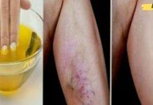 მხოლოდ ამ ინგრედიენტის გამოყენებით შეგიძლიათ სამუდამოდ მოიცილოთ ვარიკოზული ვენები!