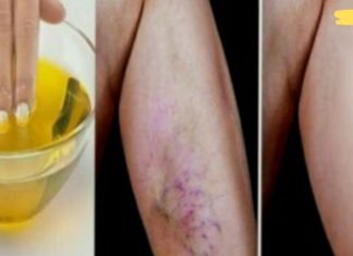 მხოლოდ ამ ინგრედიენტის გამოყენებით შეგიძლიათ სამუდამოდ მოიცილოთ ვარიკოზული ვენები!