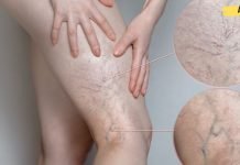 მოიშორეთ სისხლძარღვები ფეხებიდან წამლებისა და ოპერაციის გარეშე! ძალიან ეფექტური მეთოდია!!